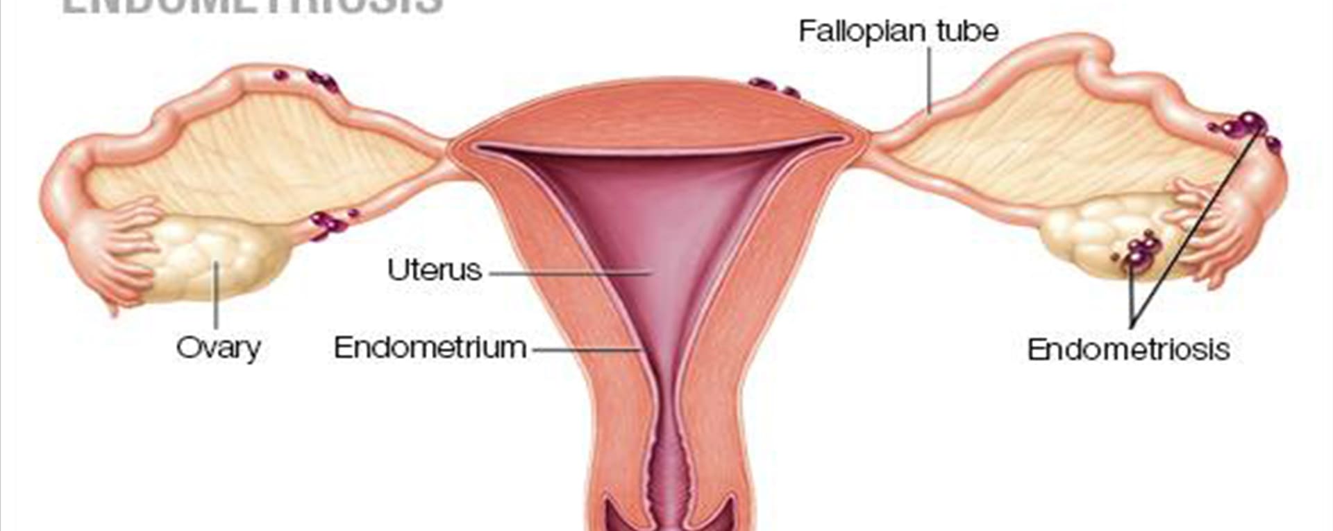 ENDOMETRIOSIS